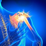 ShoulderPainMap Shoulder pain illustration showing highlighted shoulder joint discomfort